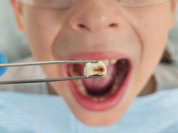 Best Emergency Tooth Extraction in Mill Plain, CT